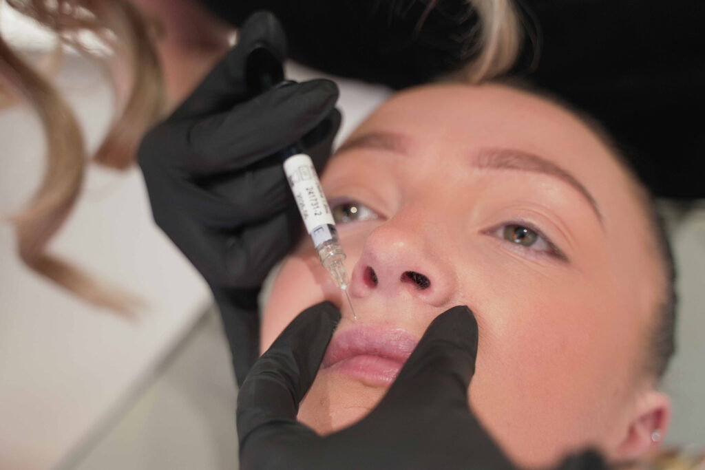 Lip fillers Exeter at Exthetics