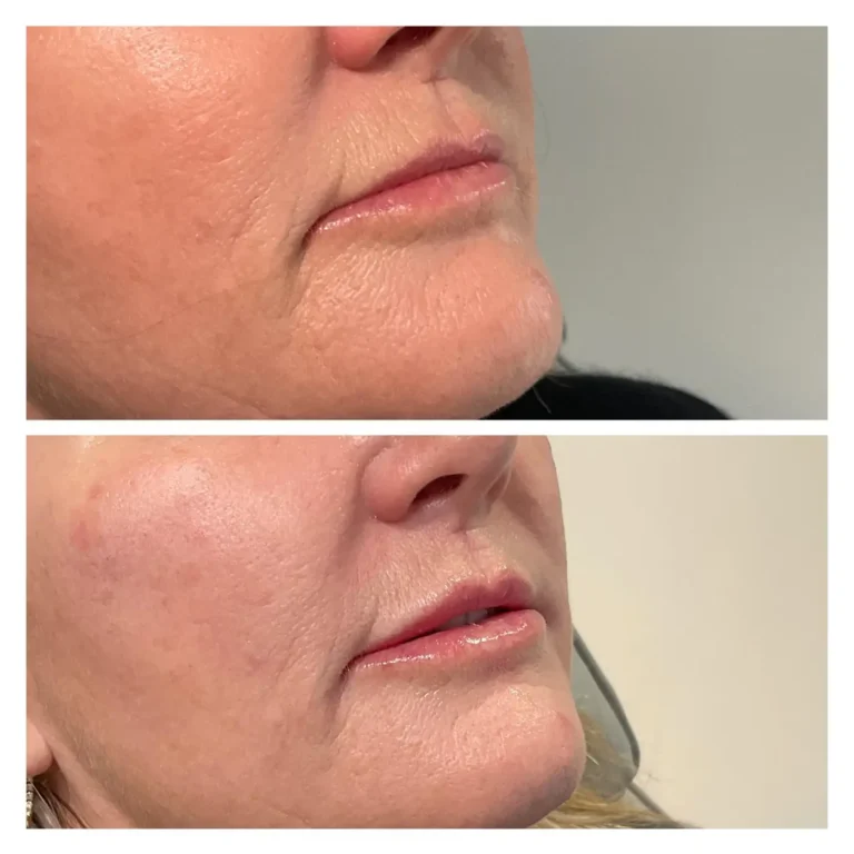 Lip fillers Exeter at Exthetics