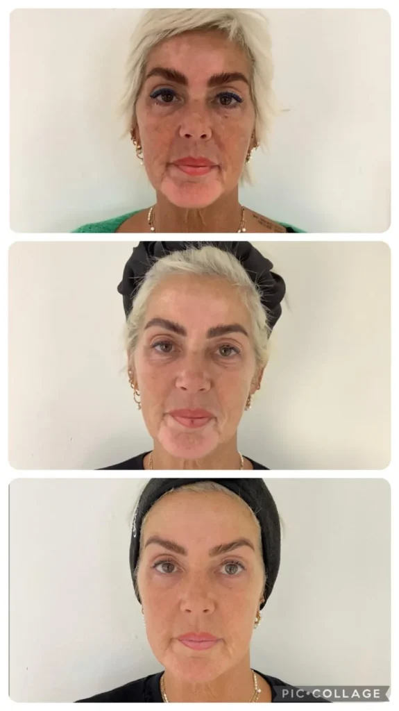 Obagi skincare reviews Exeter -Best retinol cream Astrids skin journey