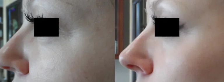 Under Eye Wrinkle Treatment - RF Microeedling