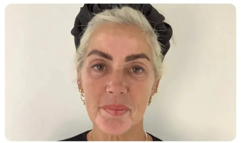 Obagi Skincare Reviews Exeter - Astrid week 4