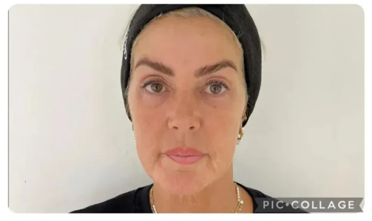 Obagi Skincare Reviews - Astrid Weeks 8-12