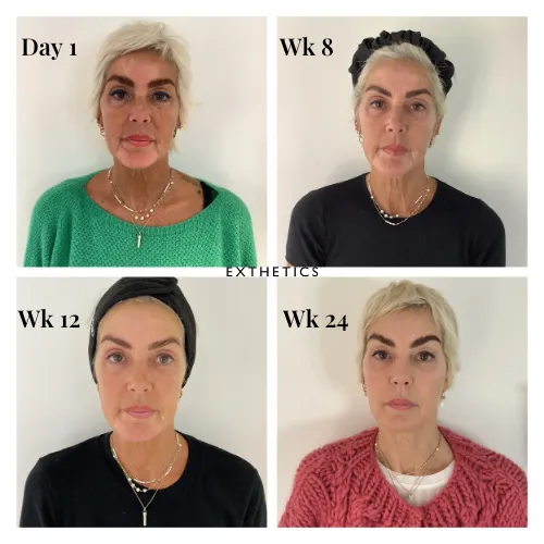 Astrids RF microneedling and skin journey at Exthetics